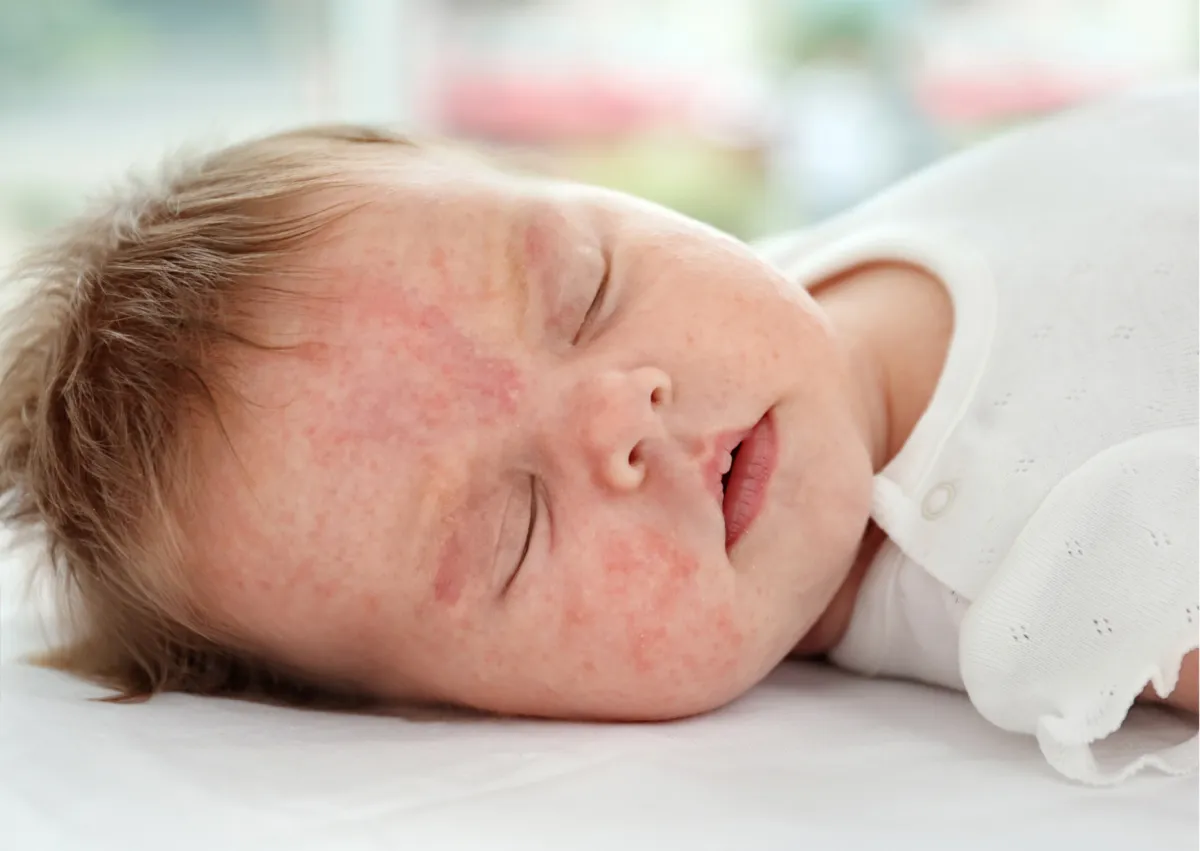 różnica nietolerancja laktozy alergia białka mleka krowiego niemowlę