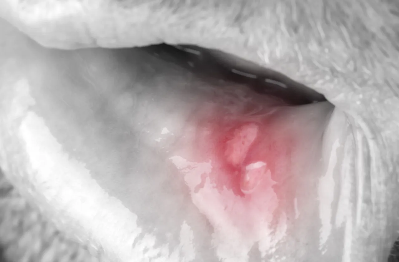 domowe sposoby na afty na dziąsłach