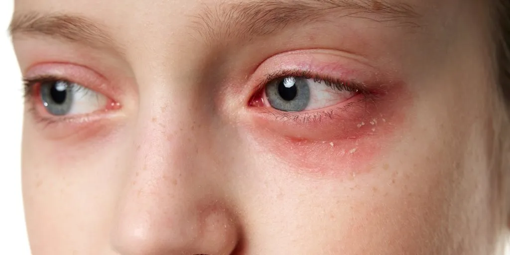 Opuchnięte, czerwone oko alergia