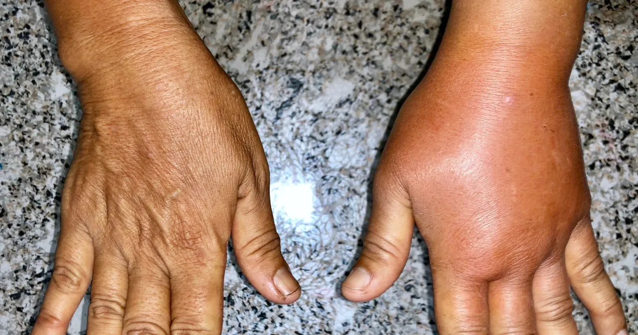 Lekarz angiolog konsultacja