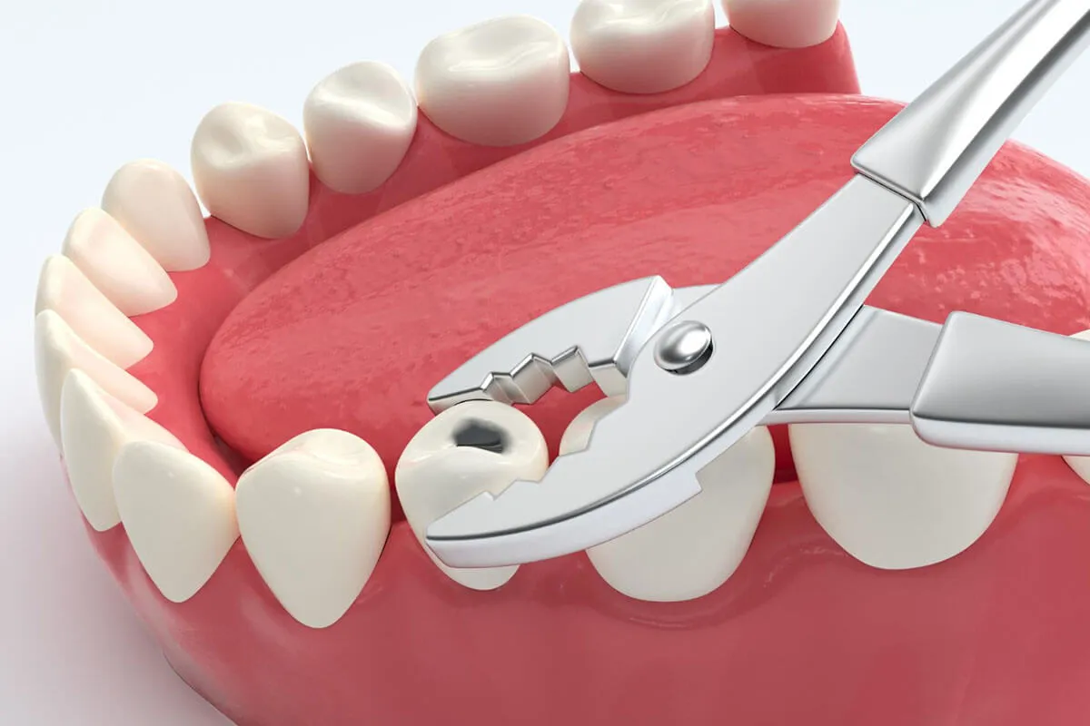 Cennik usunięcia zęba tabela