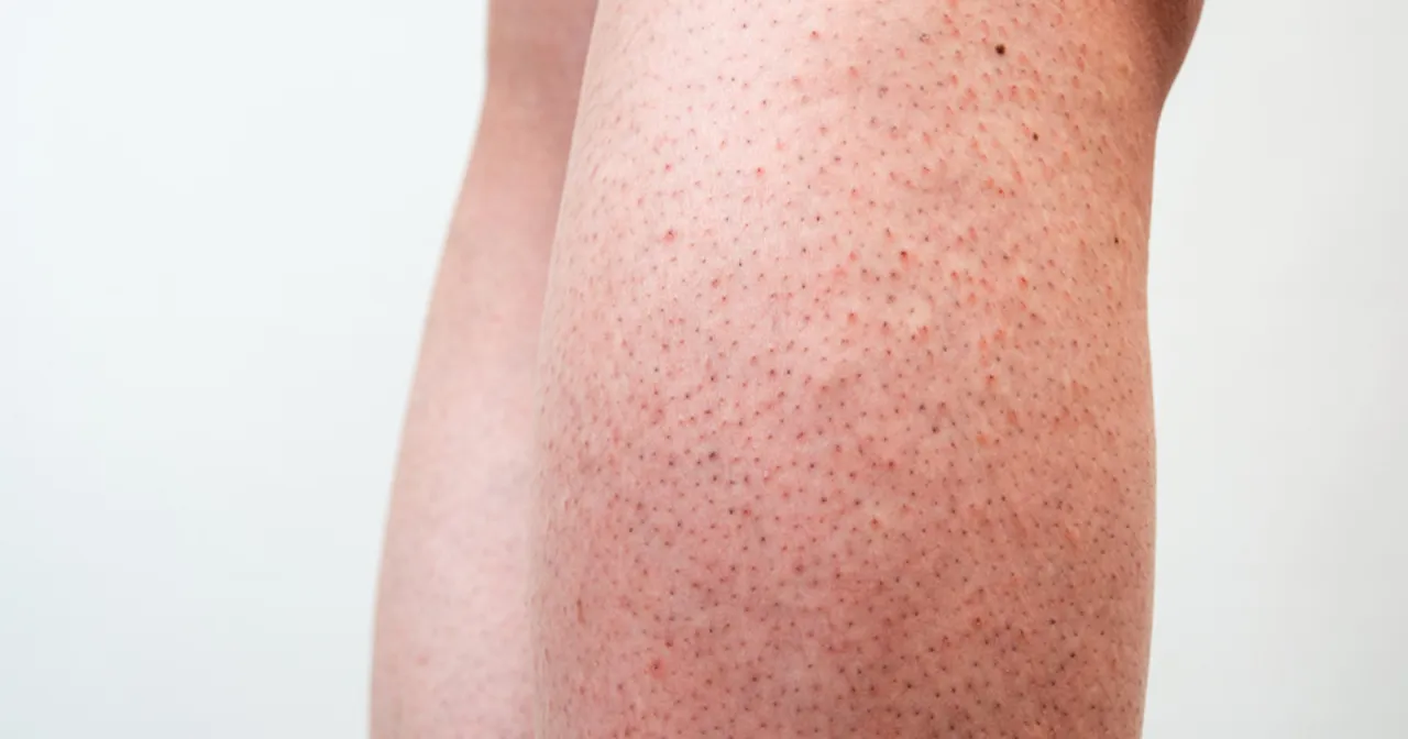 kobieta podrażnione nogi po goleniu