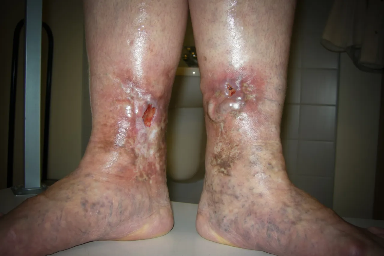 zakrzepica objawy, krwawiący żylak