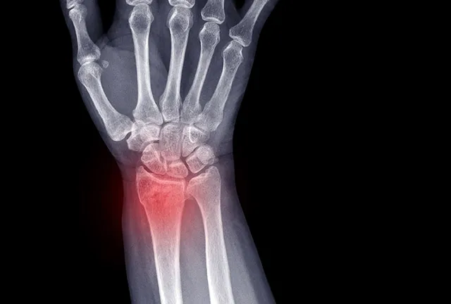 R&oacute;żne rodzaje złamań ręki na zdjęciu rentgenowskim