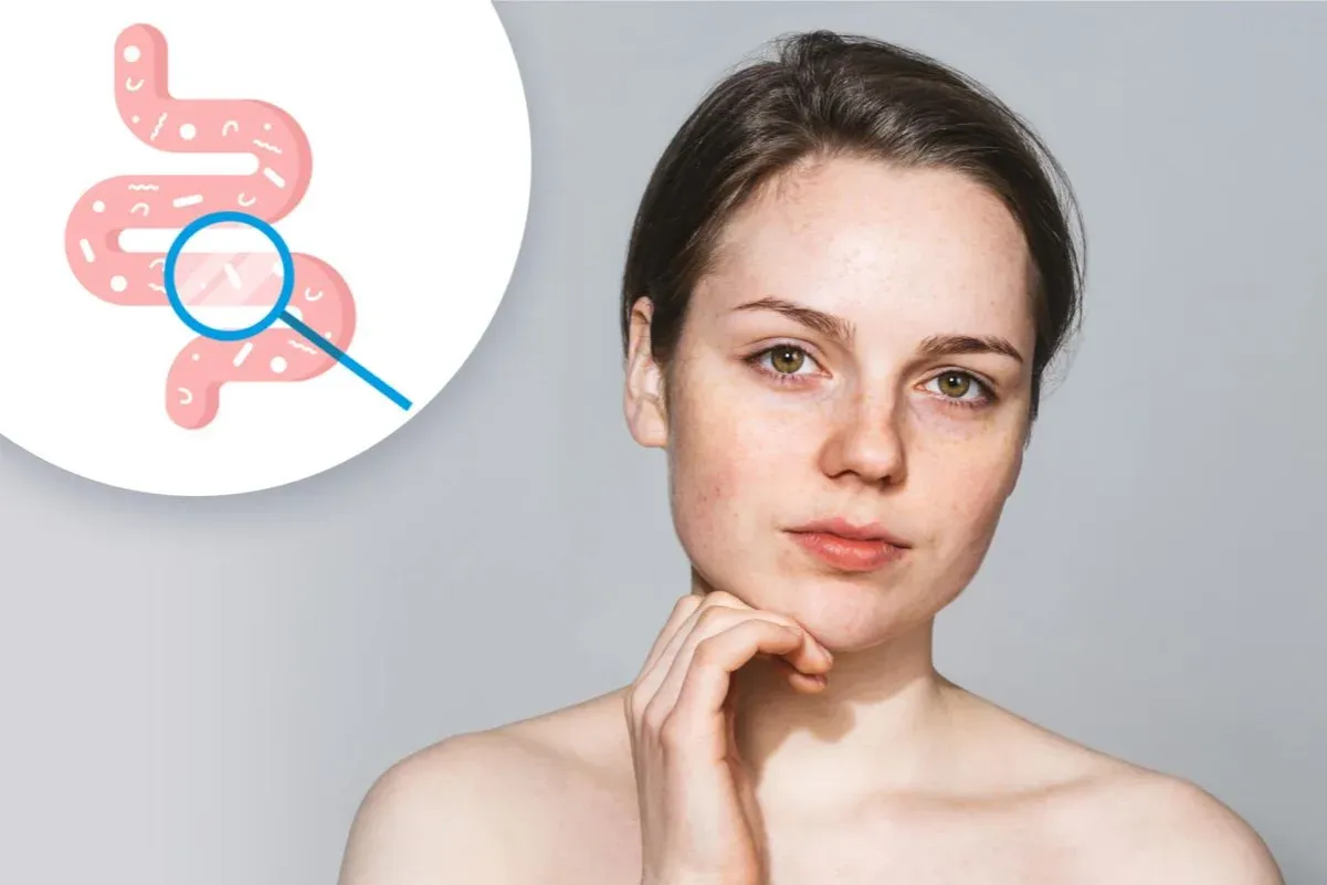 Objawy skórne dysbiozy jelitowej
