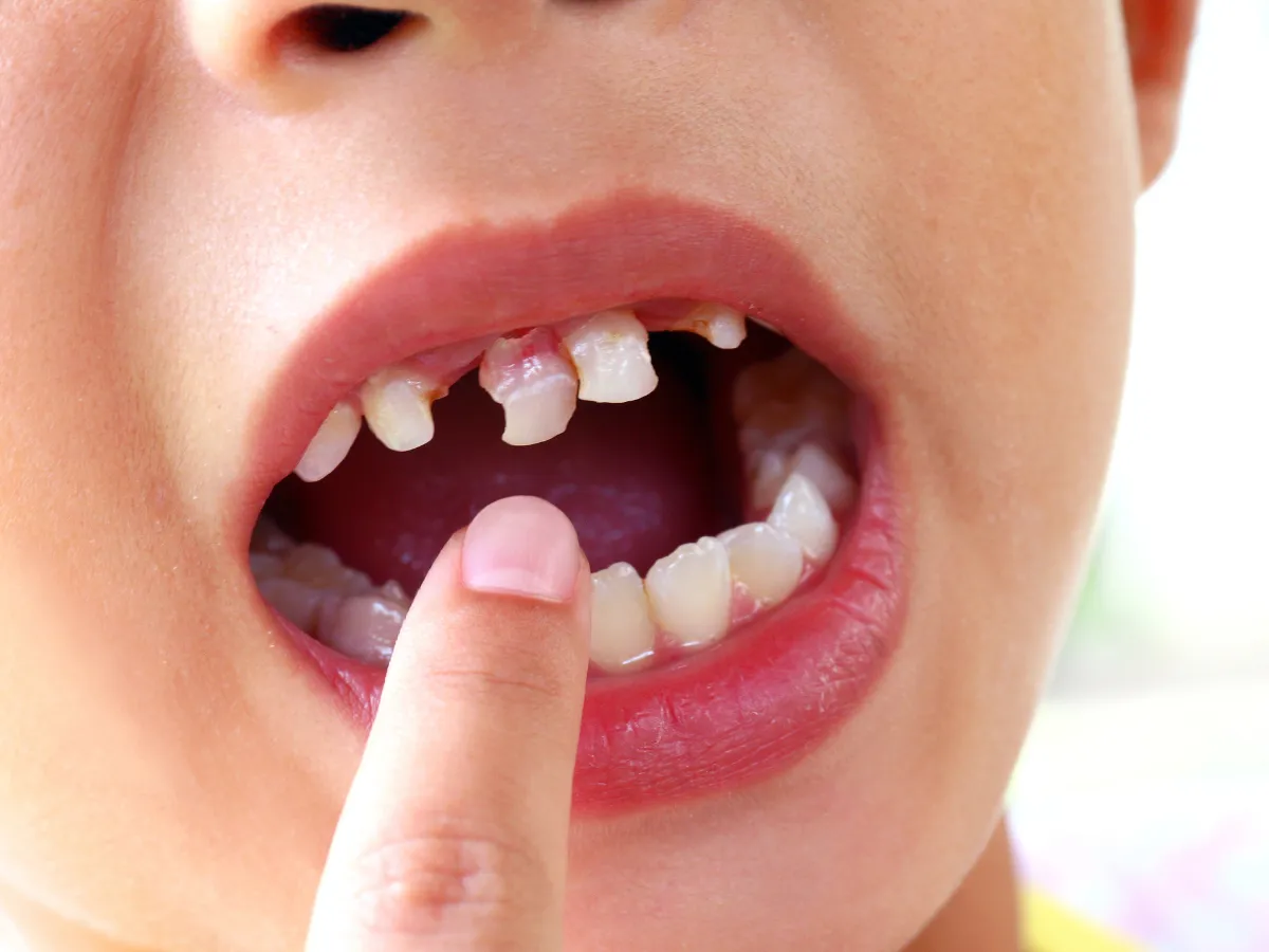 dziecko z zębami mlecznymi