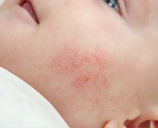 objawy atopowego zapalenia skóry u niemowląt zdjęcia