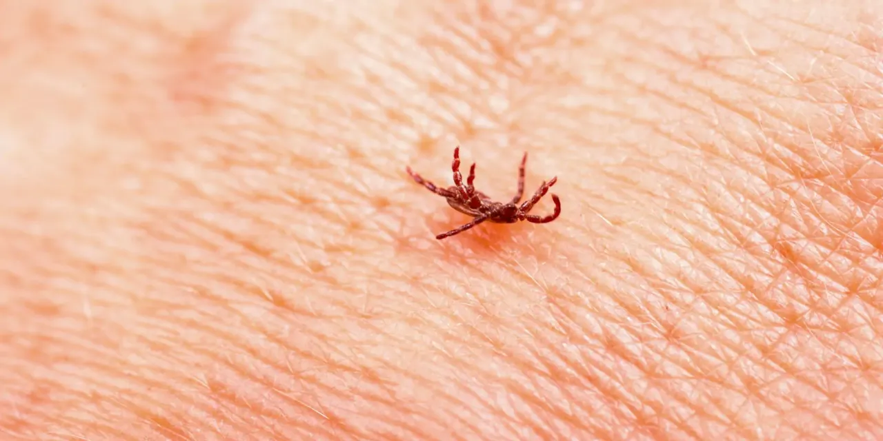 jak usunąć kleszcza pęsetą