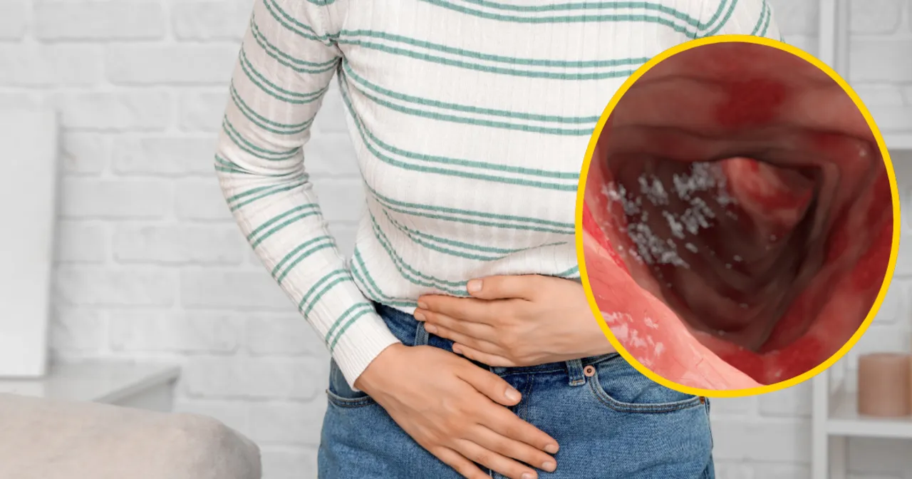 Choroby jelita grubego przyczyny