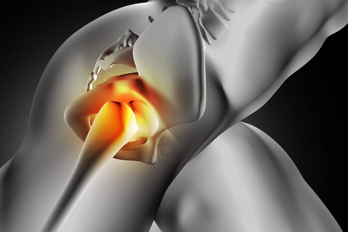 Ilustracja przedstawia staw biodrowy z zaznaczonym obszarem bólu, sugerującym skręcenie stawu biodrowego objawy.