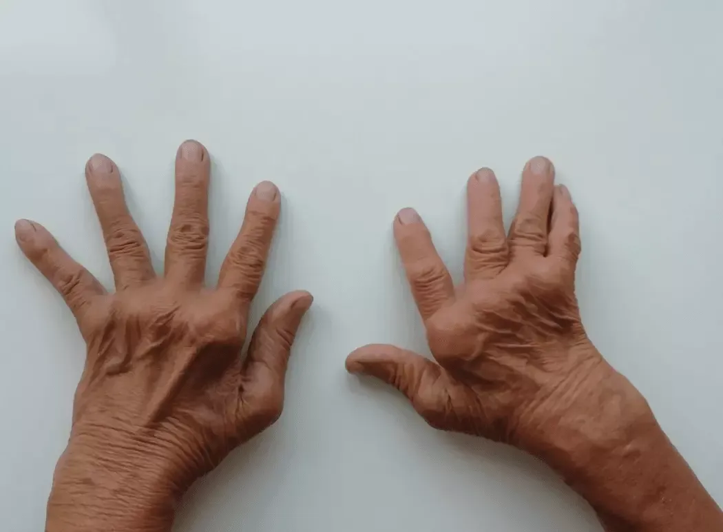 reumatoidalne zapalenie staw&oacute;w dłonie, zniekształcenia rąk RZS