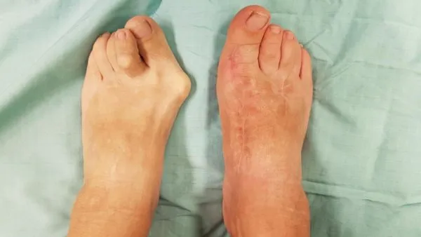 Operacja haluksów przed i po