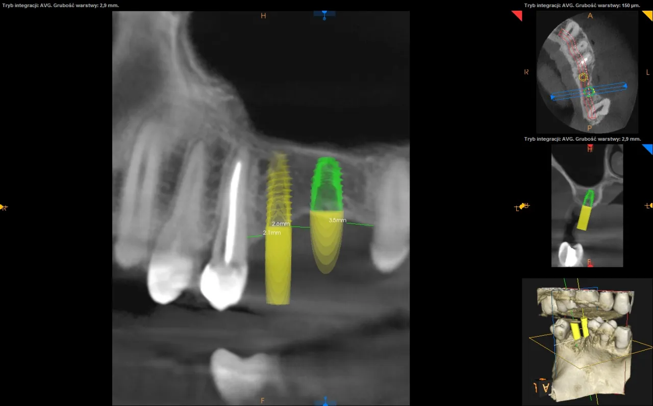 Tomografia CBCT planowanie implantu