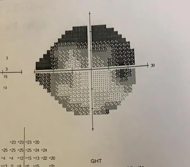 Zawężone pole widzenia jaskra, perymetria