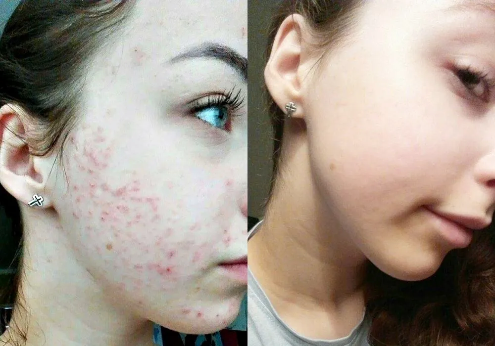 Izotretynoina przed i po trądzik