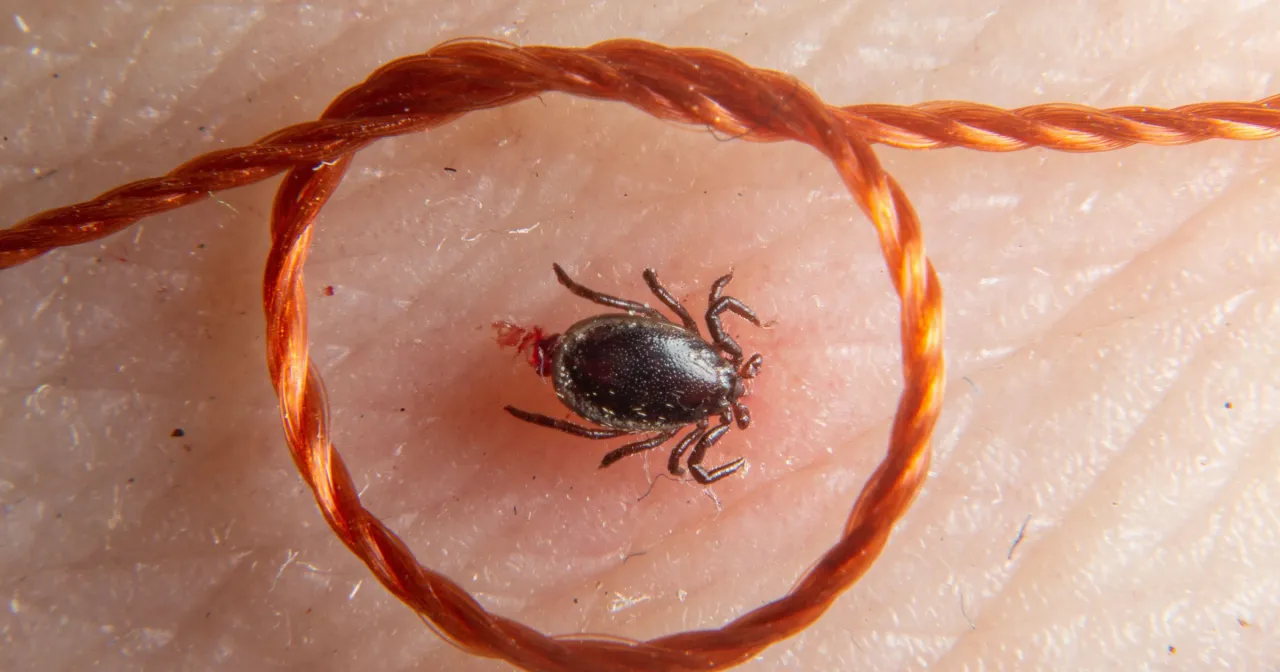 Awaryjne usuwanie kleszcza nitką lub palcami