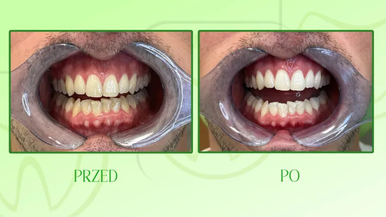 wybielanie zęb&oacute;w u dentysty przed i po