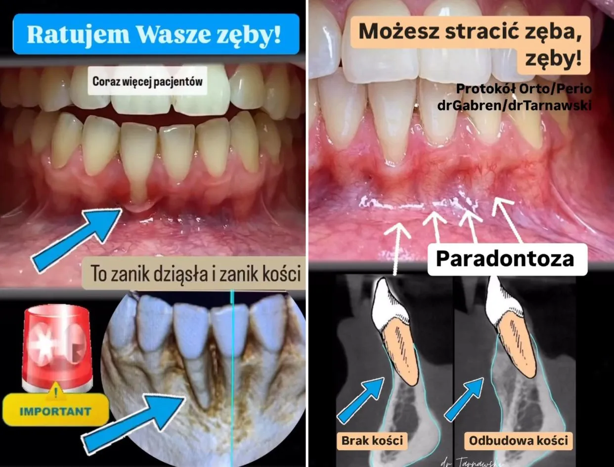 recesja dziąseł przykłady