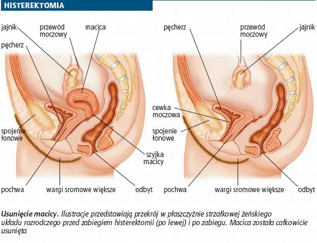histerektomia nadszyjkowa schemat porównanie macicy przed i po zabiegu