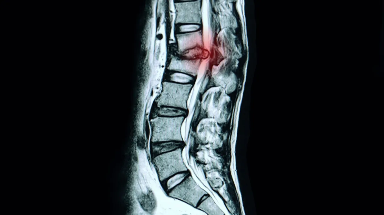 Stufenlagerung Bandscheibenvorfall LWS