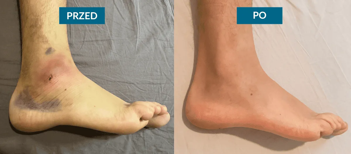 Skręcona kostka objawy i diagnostyka