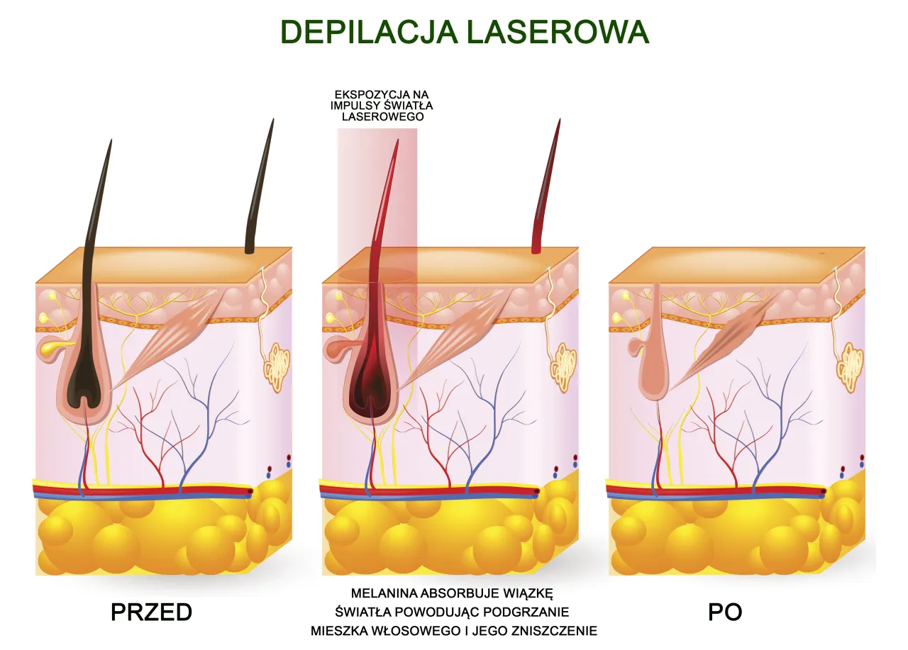 mapa ciała depilacja laserowa