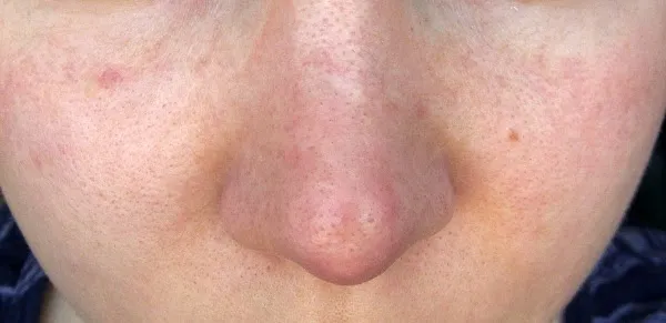 Dermatolog cera tłusta kiedy iść