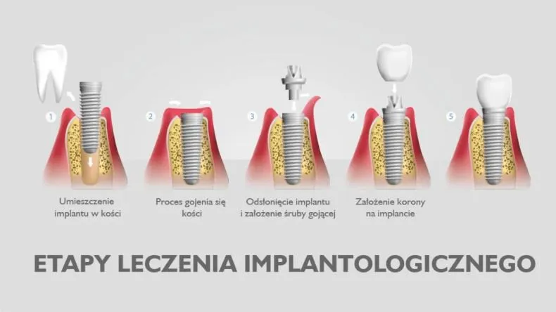 implant zęba etapy leczenia wizualizacja