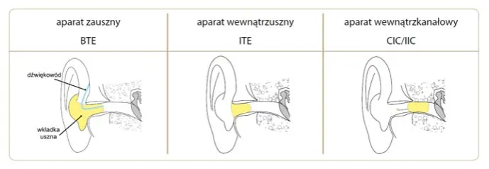 rodzaje aparat&oacute;w słuchowych por&oacute;wnanie