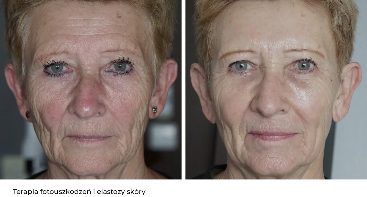 Czynniki wpływające na liczbę zabieg&oacute;w laserem frakcyjnym