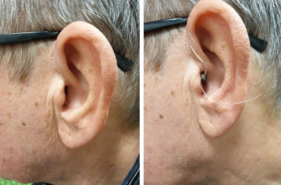 aparat słuchowy w uchu prawidłowe umieszczenie