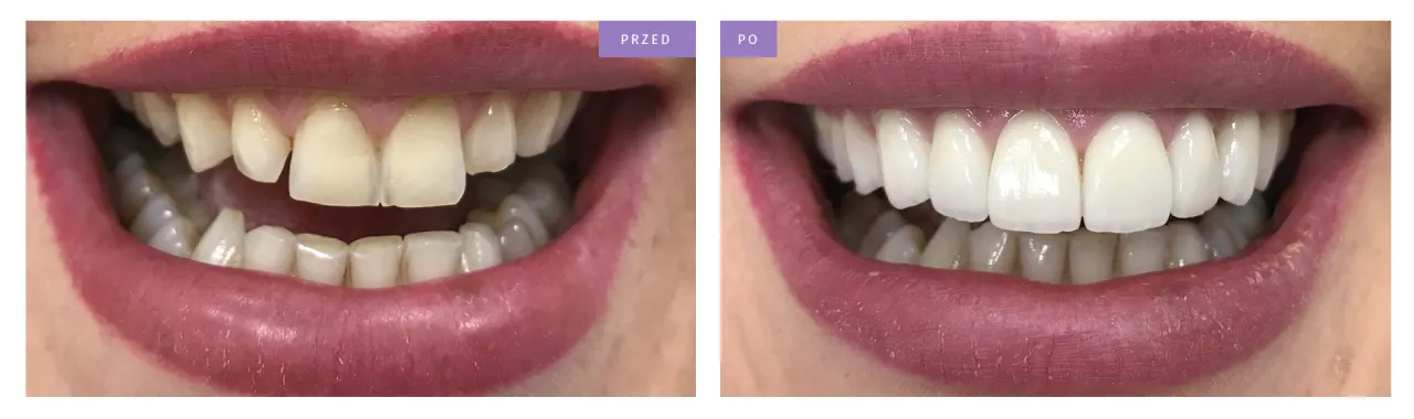 licówki porcelanowe przed i po