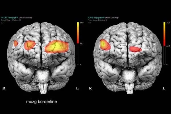 mózg zaburzenia osobowości różnice