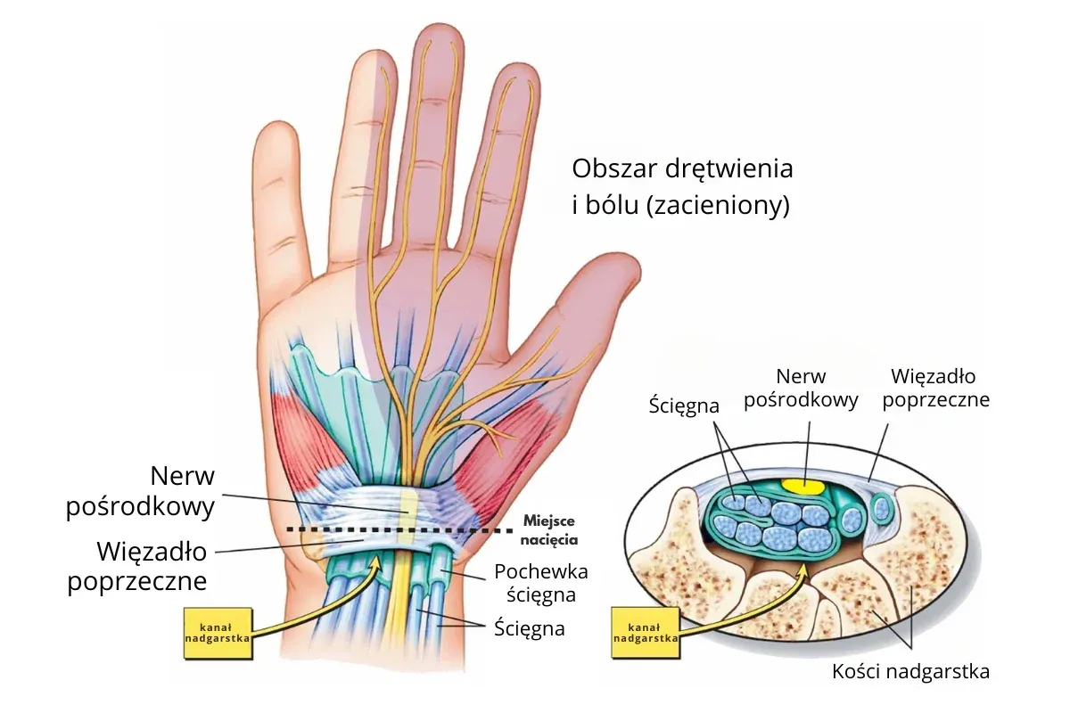 Pierwsza pomoc skręcony nadgarstek RICE