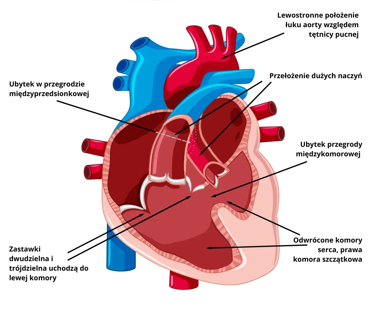 wrodzone wady serca schematy