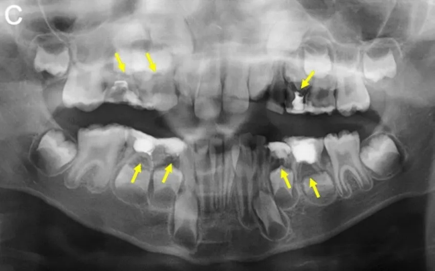 Zdjęcie Ropień mózgu od zęba objawy: jak rozpoznać niebezpieczne sygnały
