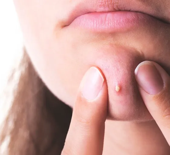 Zdjęcie Jak szybko zagoić ranę po pryszczu - skuteczne metody na blizny