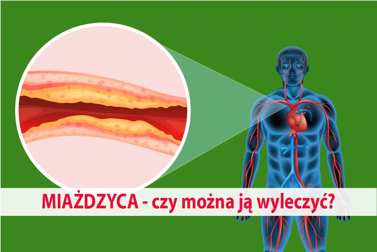 Zdjęcie Jakie leki na miażdżycę mogą uratować Twoje serce i zdrowie?