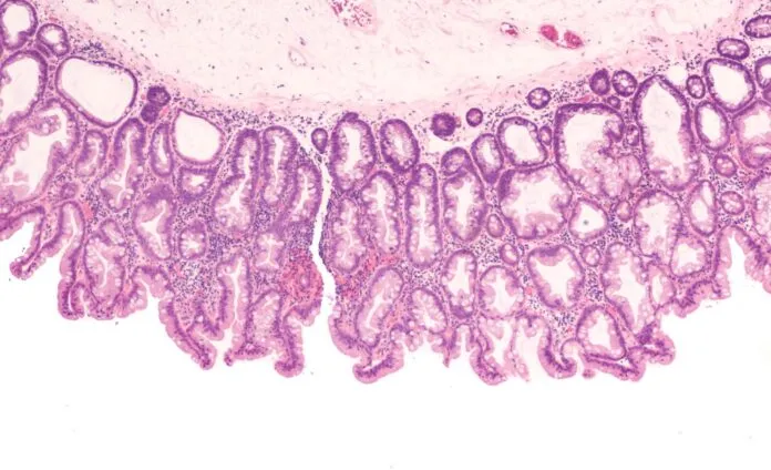 Zdjęcie Skąd się biorą gruczolaki? Zaskakujące przyczyny ich powstawania i ryzyka