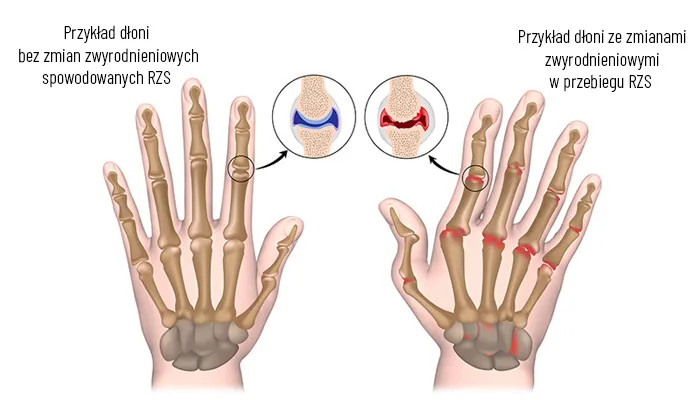 Zdjęcie Badanie anty-CCP co to jest i jak wpływa na diagnozę RZS