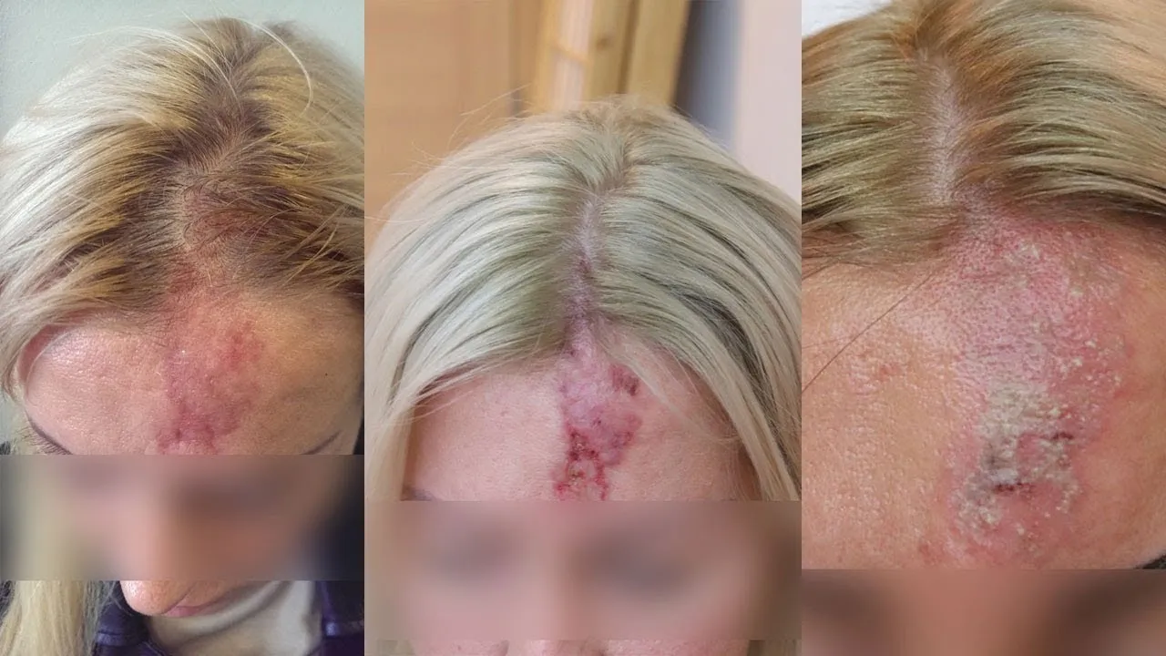 Zdjęcie Co niszczy kwas hialuronowy? Poznaj niebezpieczeństwa i skutki
