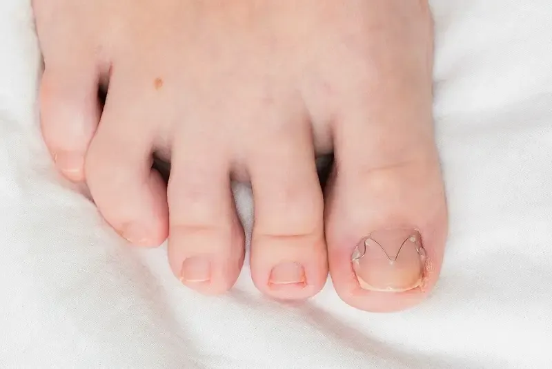 Zdjęcie Jak założyć klamrę na wrastający paznokieć i uniknąć bólu