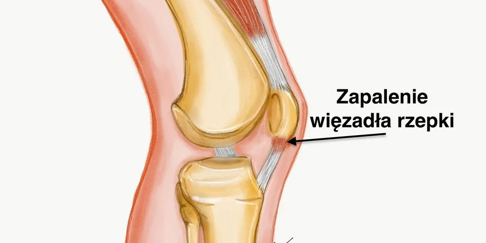 Zdjęcie Naciągnięte ścięgno w kolanie - 5 objawów, które musisz znać