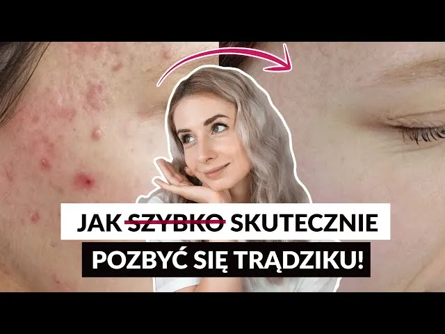 Zdjęcie Skuteczne sposoby na pryszcze: jak szybko pozbyć się problemu