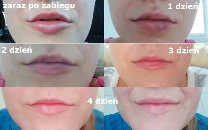 Zdjęcie Jak skutecznie zmniejszyć opuchliznę ust po kwasie hialuronowym?