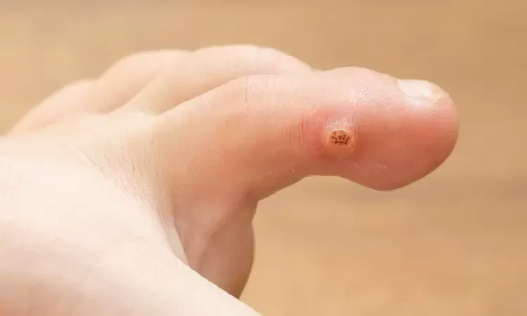 Zdjęcie Skąd się biorą kurzajki? Oto przyczyny, objawy i sposoby zapobiegania