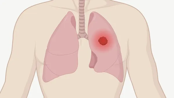 Zdjęcie Symptome von Lungenkrebs bei Frauen: Warnzeichen, die Sie beachten sollten