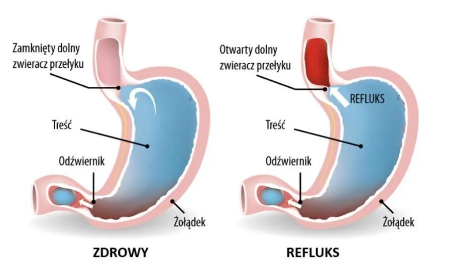 Zdjęcie Refluks blog: Wszystko o objawach i skutecznym leczeniu zgagi