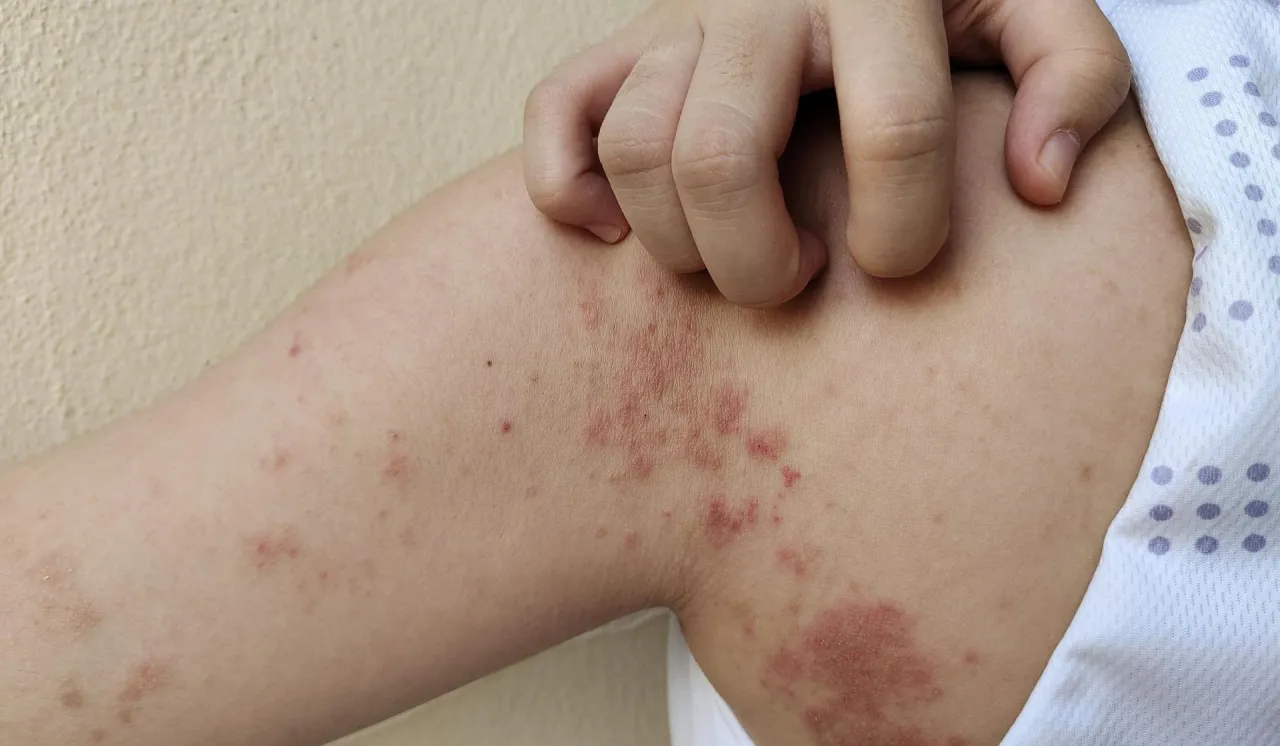 Zdjęcie Objawy ugryzienia pająka: jak rozpoznać niebezpieczne symptomy