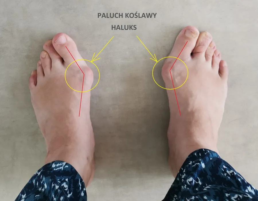 Zdjęcie Jak wygląda haluks? Objawy, zdjęcia i metody leczenia deformacji stopy